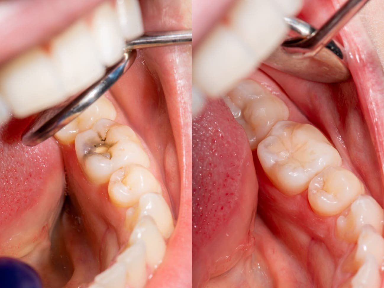 Dental Fillings Image