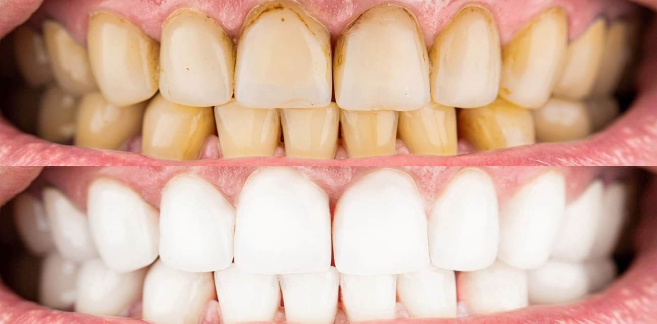 Teeth Whitening Image